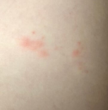 대상포진 초기 증상과 통증이 심해지기 전 알아둘 점 많은 사람들이 놓치는 결정적인 신호